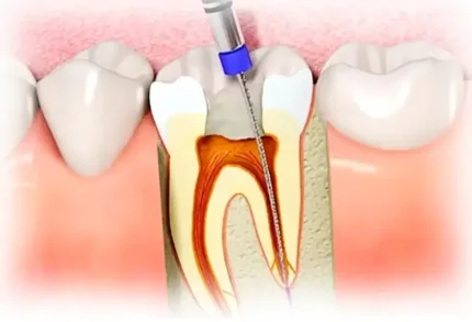 Эндодонтическое лечение пульпита 1 корневого зуба в Благовещенске