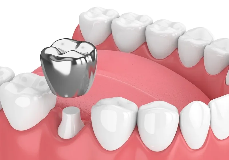 Протезирование зубов: стальная коронка