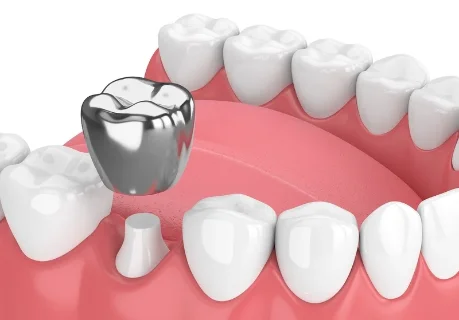 Фото для Протезирование зубов: стальная коронка