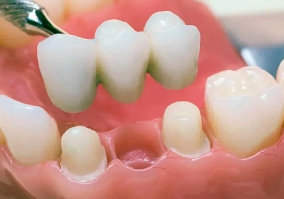 Протезирование зубов: металлокерамическая коронка