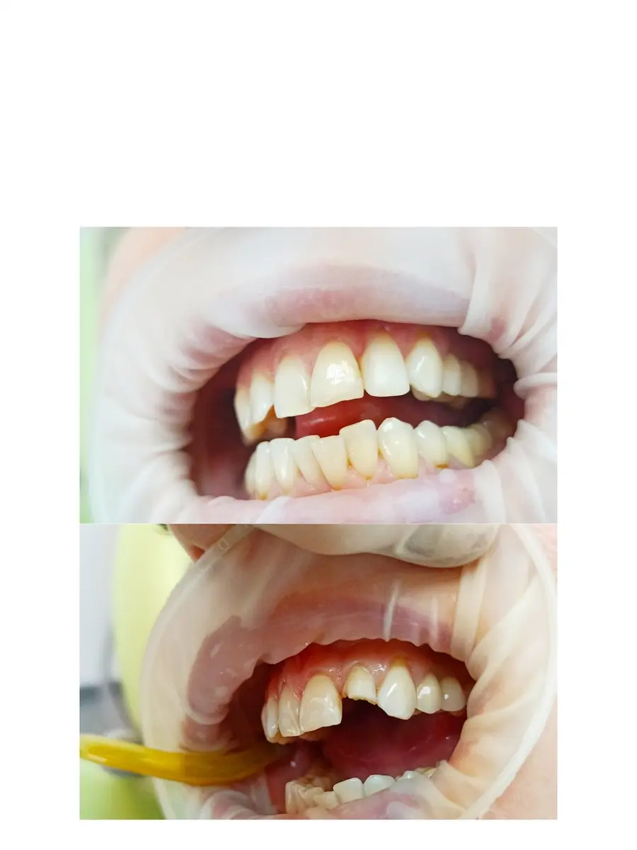 Реставрация зуба лечение зубов восстановление зубов в Благовещенске     