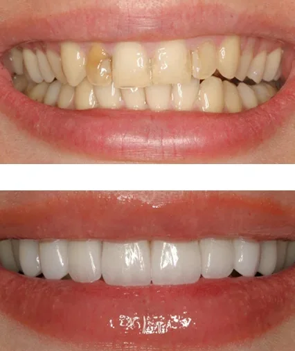 Восстановление зуба прямыми винирами
