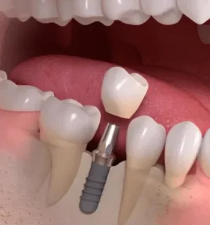 Фото для Имплантация зубов под ключ. Тариф "Базовый"