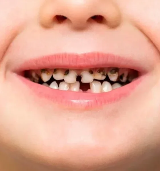 Лечение пульпита зуба у детей