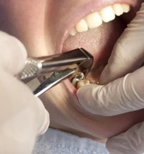 Удаление постоянного зуба
