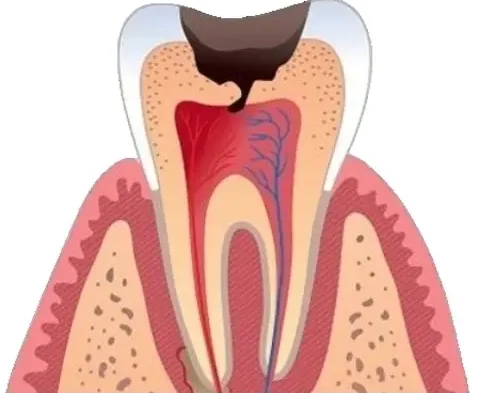 Лечение пульпита постоянного зуба