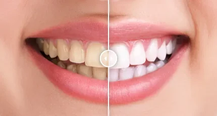 Эстетическая стоматология: Фотоотбеливание зубов линии улыбки (обе челюсти).