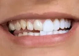 Фото для Косметическая реставрация более 1/2 зуба (полная)