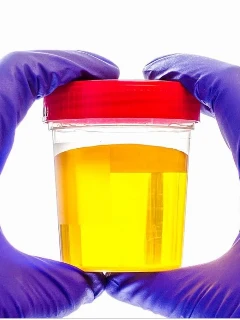 Анализ мочи на микроальбуминурию (экспресс метод)