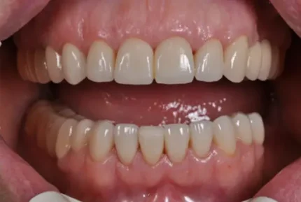 Несъемное протезирование зубов: металлокерамическая коронка.