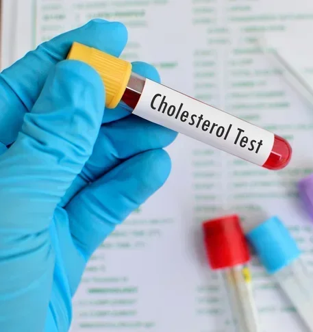 Анализ крови на холестерин общий (Cholesterol total)
